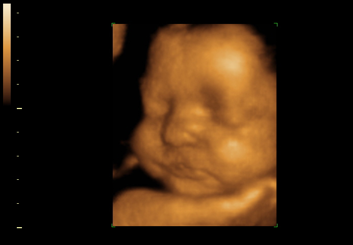 3D ultrasound image at 30 weeks